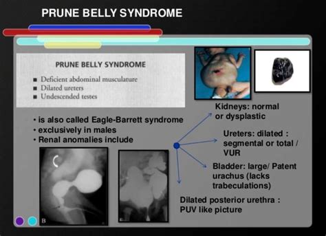 Prune belly syndrome | Pediatric nursing, Syndrome, Pediatrics