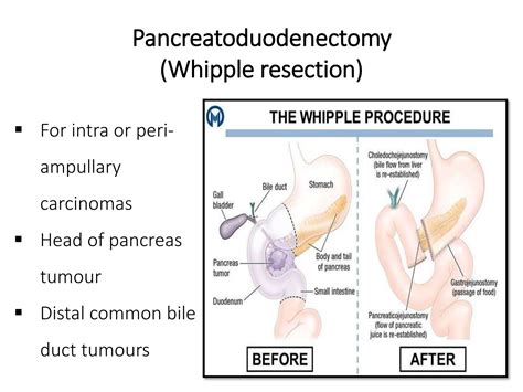 1422 Dr Tanaya Grossing Whipples .pptx | Surgery | Medical Health 