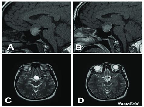 The Brain Mri T A And T C And D Images Images Show The Sellar And