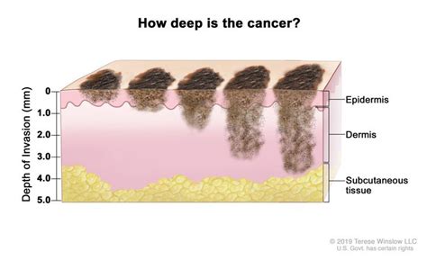 Stage 4 Melanoma Skin Cancer