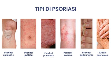 Psoriasi Cause E Trattamenti Limportanza Dellalimentazione