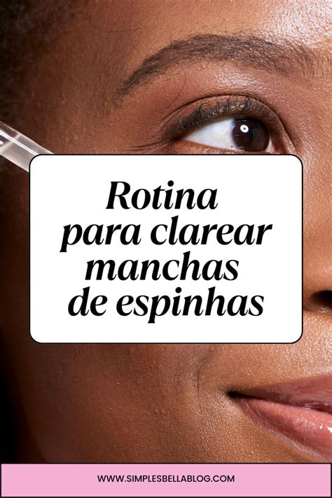 Como Clarear Manchas De Acne Em At Semanas Manchas De Espinhas