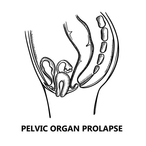 Pelvic Organ Prolapse Sketch Education Scheme Vector Set 20454633