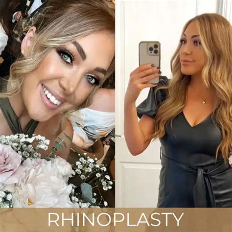 how much to nose jobs cost