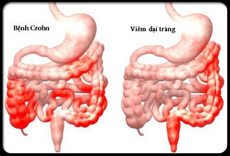 Bệnh Crohn có lây không Vinmec