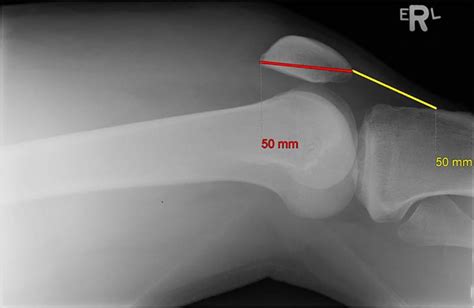 Synchronous Quadriceps Tendon Rupture And Unilateral Acl Tear In A