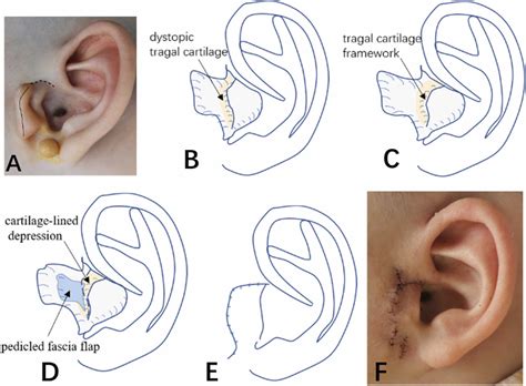 Cartilage Transposition And Anchoring A Surgical Technique For The