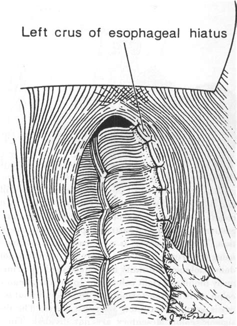 Esophageal Replacement With Colon Interposition Operative Techniques