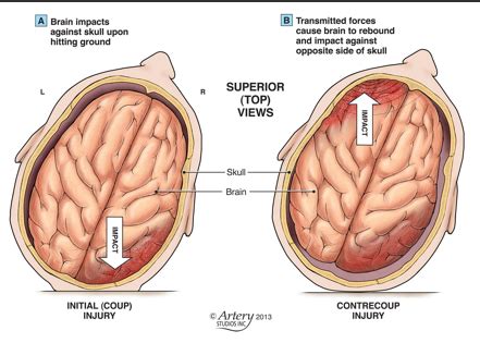 Pathology Of Traumatic Brain Injury Tbi Flashcards Quizlet