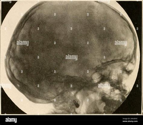 Roentgen Diagnosis Of Diseases Of The Head Onsidering The Prominence