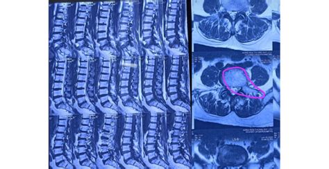 MRI of the lumbar spine showing protrusion | Download Scientific Diagram