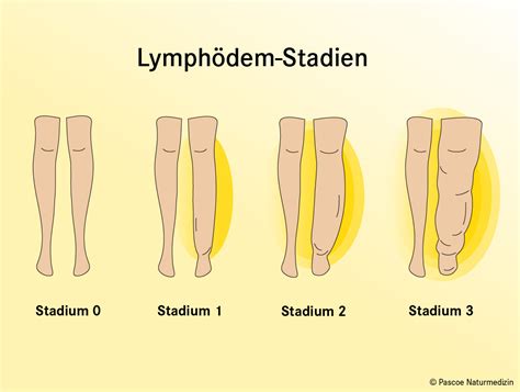 Lymphödem Was können Sie selbst tun