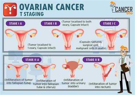 Pin On Ovarian