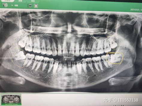 长沙市口腔医院拔牙记录 知乎