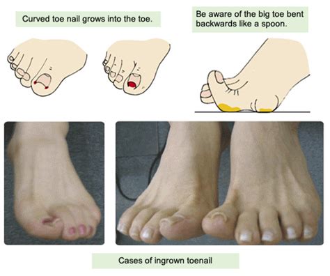 Curved Toenails Treatment - My Bios