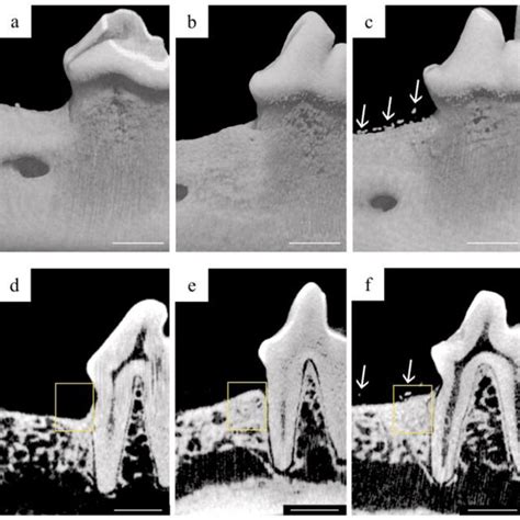 Micro Computed Tomography Evaluation D Aec And D Def