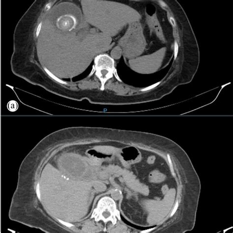 A Axial View Of The Abdominal CT At Level Of T12 Vertebrae Showing