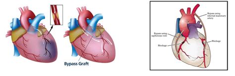 Know About Coronary Bypass Surgery Arneja Heart And Multispeciality