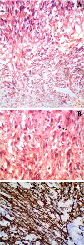 A Hande 40× Section Shows Intersecting Fascicles Of Malignant Spindle