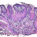 Condyloma Acuminatum – Dermpath Diagnostics