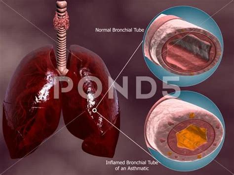 Trachea Cross Section With Lungs Showing Normal And Asthmatic