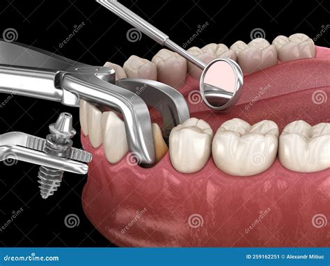 Extraction And Implantation Complex Immediate Surgery Medically Accurate 3d Illustration Of