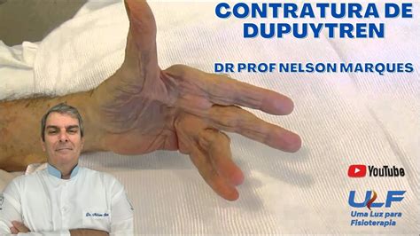 CONTRATURA DE DUPUYTREN Dr Prof Nelson Marques YouTube