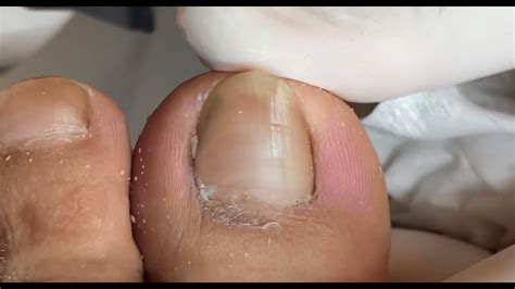 Dirty Ingrown Toenail Cleaning And Cutting He Pedicure YouTube