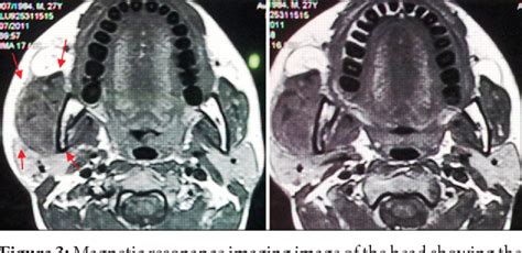 Figure 1 From Tubercular Osteomyelitis Of The Condyle And Ramus Of The Mandible A Case Report