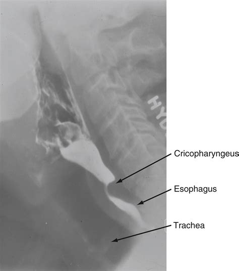 Esophageal Neuromuscular Function And Motility Disorders Clinical Tree