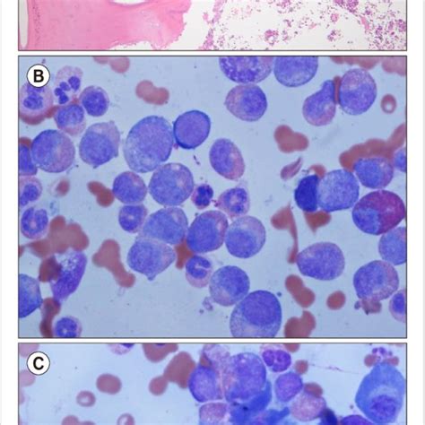 Bone Marrow Biopsy And Aspiration At Diagnosis A Bone Marrow Biopsy