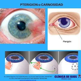 Cl Nica De Ojos Oftalmic L Ser Pterigion O Carnosidad Enfermedades