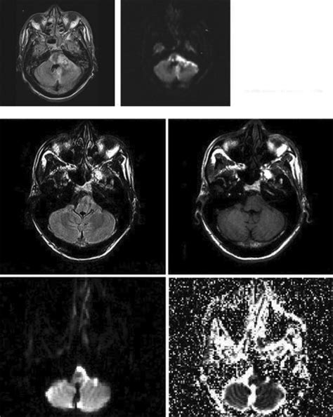Repeat Mri Top Panel Revealed Fourth Ventricle Effacement And Infarct