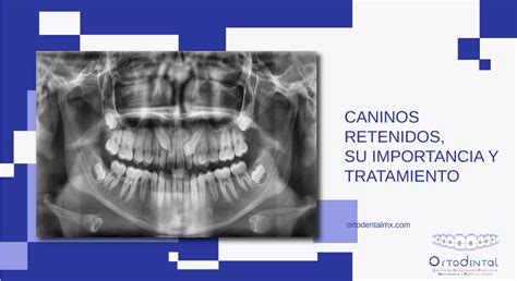 Caninos Retenidos Su Importancia Y Tratamiento Ortodental