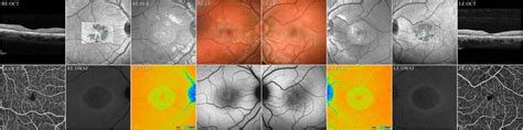 Multimodal Retinal Imaging Of Patient II 3 RE Indicates The Right Eye