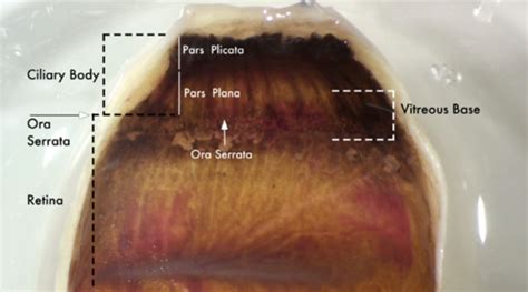 Vitreous Base Anatomy The Vitreous Base Is A Semi Transparent