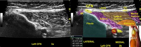 Ultrasound Guided Nerve Hydrodissection For Pain Management Rationale Jpr