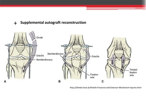 Ppt Extensor Mechanism Lesions After Total Knee Arthroplasty