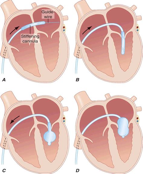 Valvular Heart Disease Thoracic Key