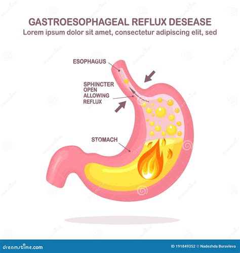 Human Stomach Gastroesophageal Reflux Disease Gerd Heartburn