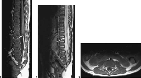 15 Caudal Regression Syndrome Radiology Key