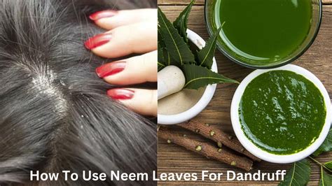 How To Use Neem Leaves For Dandruff Bright Cures