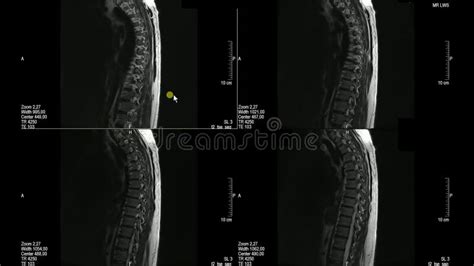 Ct Scan Thoracic Spine Ct With D Reconstruction The Film Shown