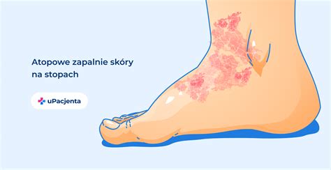 Atopowe Zapalenie Skory Azs Przyczyny Objawy Leczenie Images