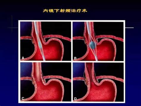 【消化吧】胃食管反流病患者的新疗法——“内镜下贲门缩紧术” 南方plus 南方