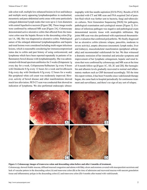 Ulcerative Colitis With Aseptic Abscesses Controlled By Vedolizumab A