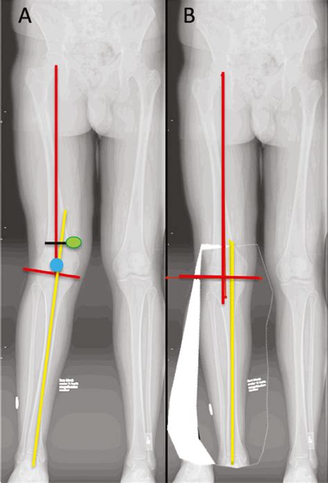 View Of Lateral Opening Wedge Osteotomy Of The Distal Femur For Genu