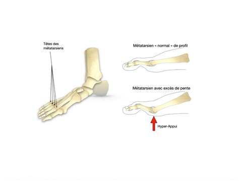 Métatarsalgies par excès de pente Dr Bovier Lapierre