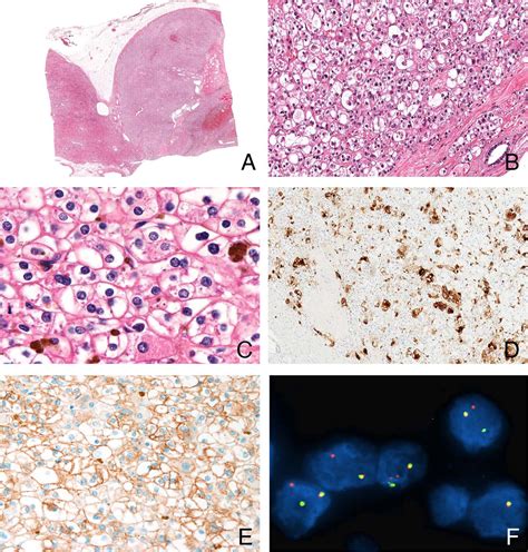 Tfeb Rearranged Renal Cell Carcinoma A Clinicopathologic And Molecular