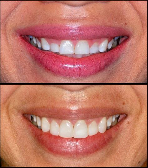 Aumento de Coroa Clínica Estético A correção da estética do sorriso